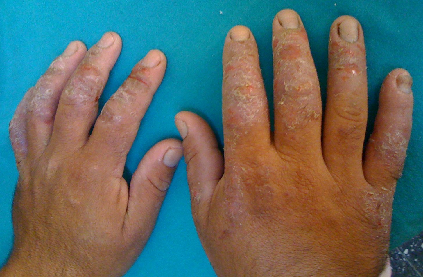 Contact dermatitis Chemotechnique Diagnostics